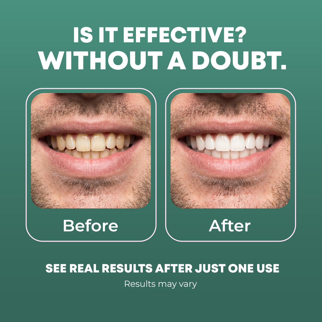 Peroxide-Free Whitening Strips (Checkout Deal)