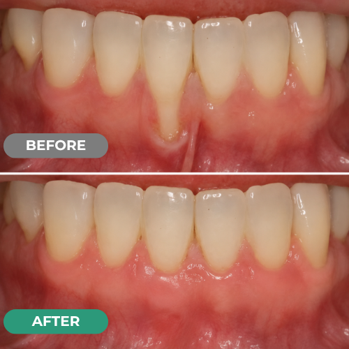 Mirarepair customer gum-care before and after comparison