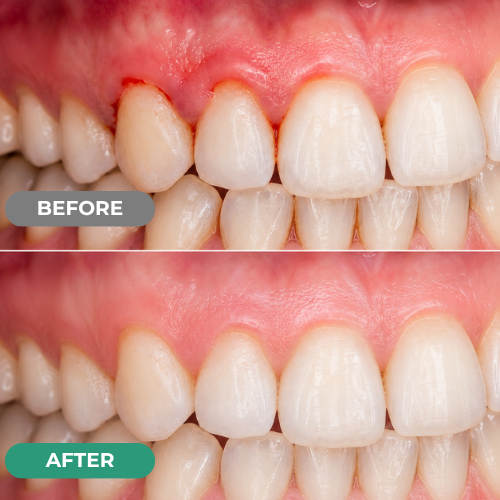 Mirarepair customer gum-care before and after comparison