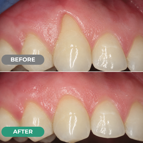 Mirarepair customer gum-care before and after comparison