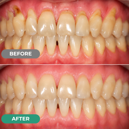 Mirarepair customer gum-care before and after comparison