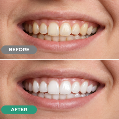 Peroxide-Free Whitening Strips