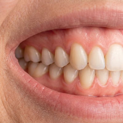 Receding Gums