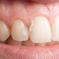 Enamel Repair
