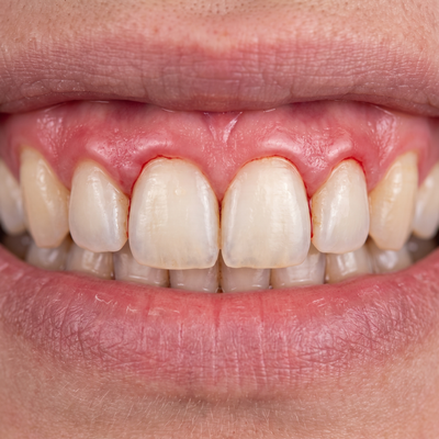 Bleeding Gums