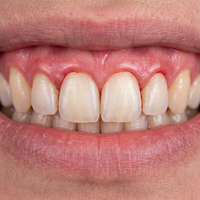 Bleeding Gums
